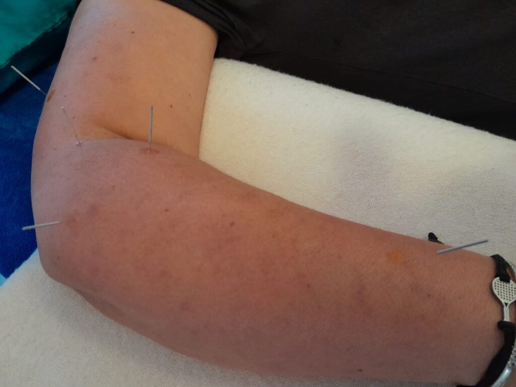 acupuncture for padel elbow