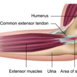 An NHS visual of tennis elbow