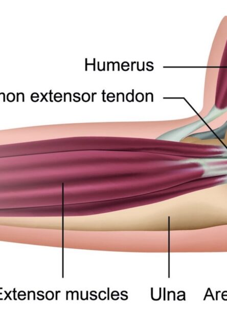 An NHS visual of tennis elbow