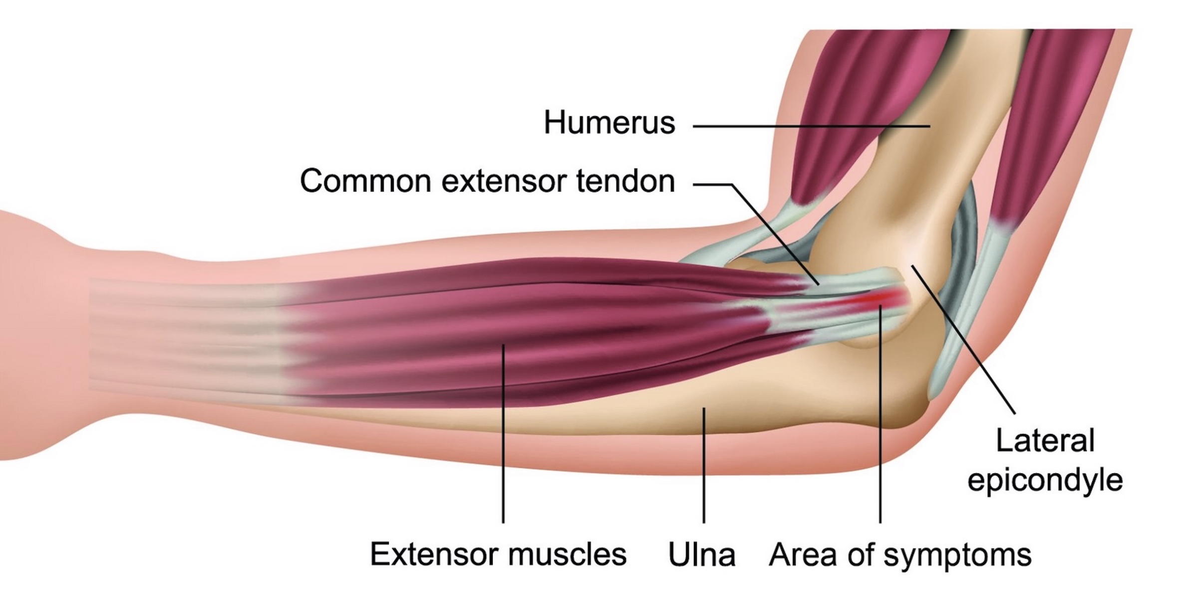 An NHS visual of tennis elbow